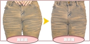 小尻矯正ストレッチ_コピー